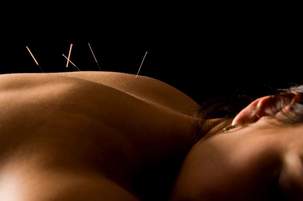 Acupuncture for pain relief