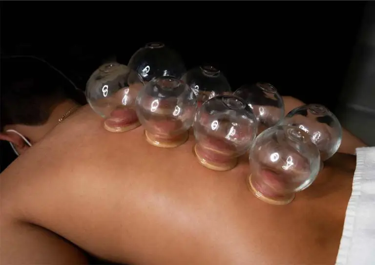 Cupping therapy on the mid-back