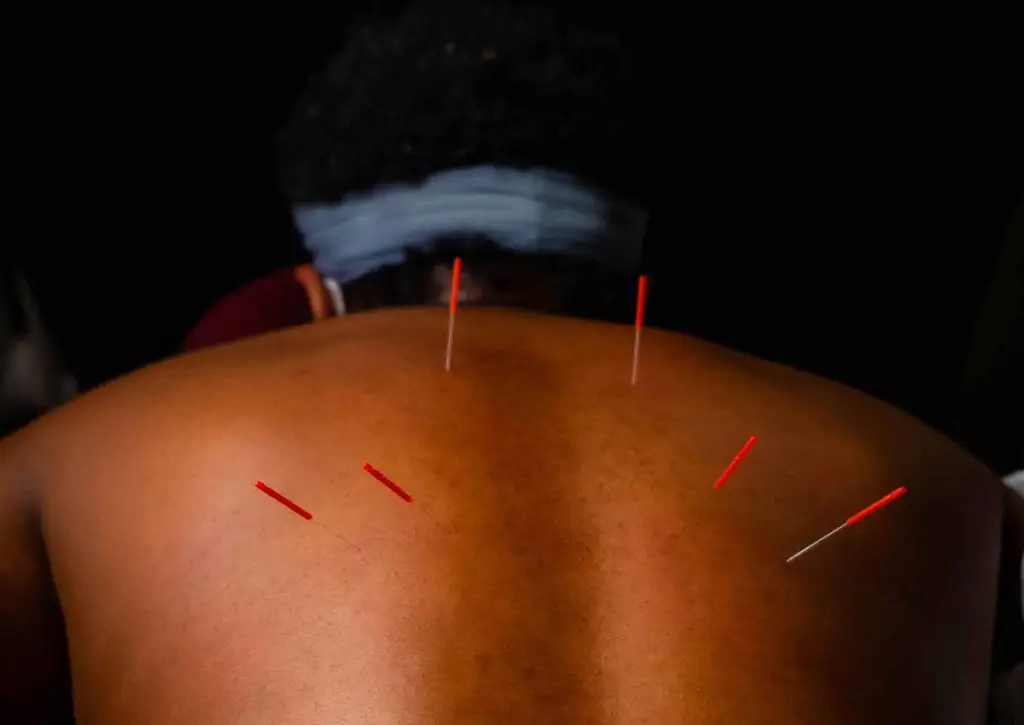 Back Pain Acupuncture NYC