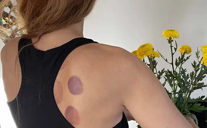 Cups create roughly 5-15mm of suction and may leave a purple circular mark that may last about 3-7 days. This mark is an indication that cupping therapy was able to draw a pathogenic factor.
