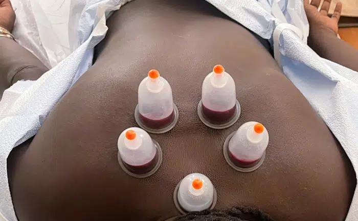 We perform wet cupping therapy by first finding tender points and using disposable push-button safety lancets to make tiny cuts on your skin. Next, we use disposable suction cups to draw out a small quantity of blood. You might get 1-5 cups in your one session.