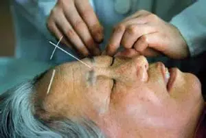 A woman's face with acupuncture needles for treating anxiety with acupuncture