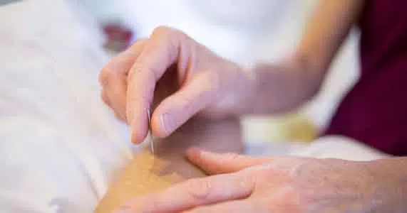 Closeup image of an acupuncturist inserting an acupuncture needle into the patient for the purpose of treating knee pain