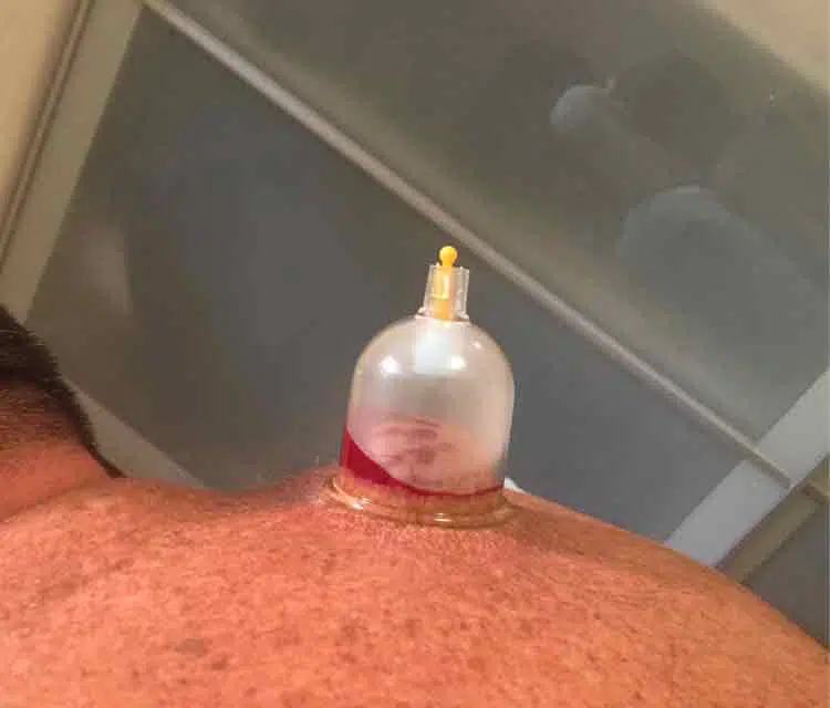 A closeup image of therapeutic suction cup on a man's shoulder.